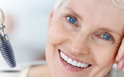 O čemu ovisi cijena zubnih implantata?