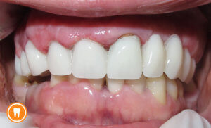 Lasersko produljenje kliničke krune zuba – Smile design