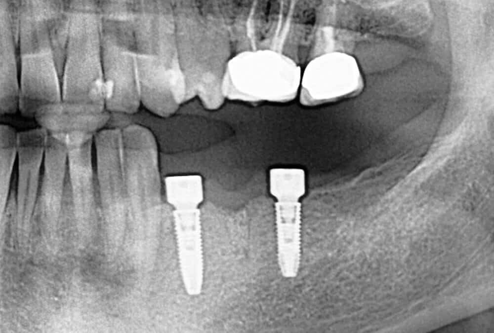 Imedijatno opterećenje na implantatima-1