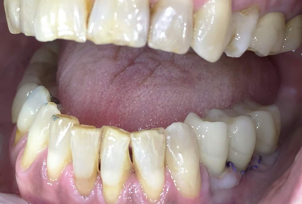 Imedijatno opterećenje na implantatima-3